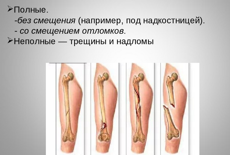 Степени тяжести переломов