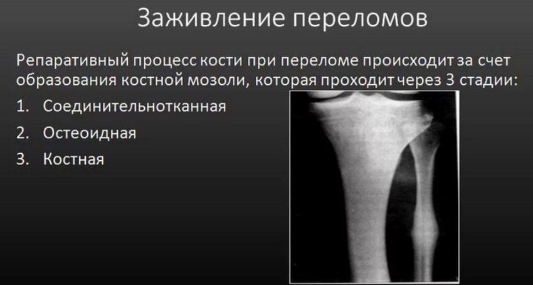 Заживление переломов, сращение костей