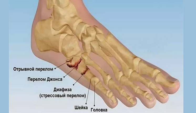 Перелом 5 (пятой) плюсневой кости стопы