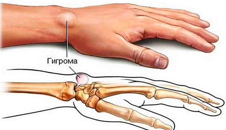 Шишка на внешней тыльной стороне правой, левой кисти