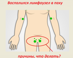 Воспалился лимфоузел в паху у женщины, мужчины: причины, что делать? Чем лечить лимфаденит: препараты, народные способы