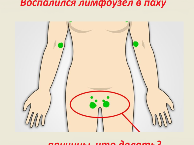 Воспалился лимфоузел в паху у женщины, мужчины: причины, что делать? Чем лечить лимфаденит: препараты, народные способы