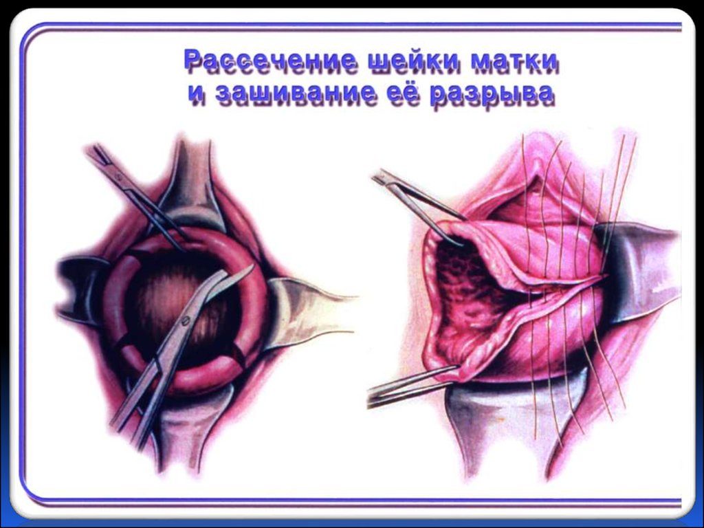 Схема рассечения