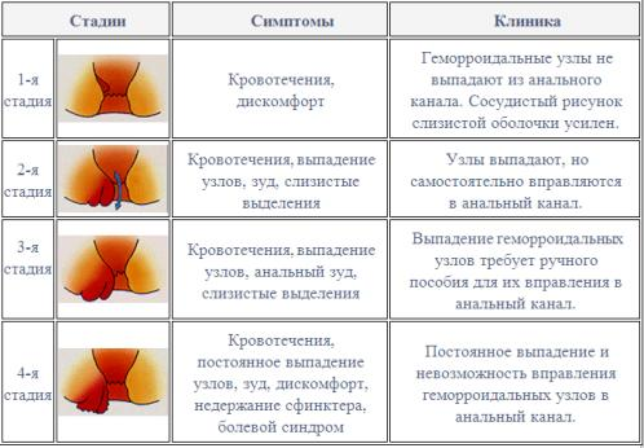 Стадии недуга