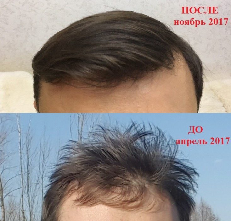 Шикарный результат после двух курсов втирания разбавленной перцовки в редеющие мужские волосы