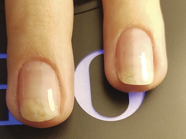 Пустота под ногтем — как избавиться: причины, симптомы, признаки, лечение ногтей на пальцах рук и ног, препараты, народные средства