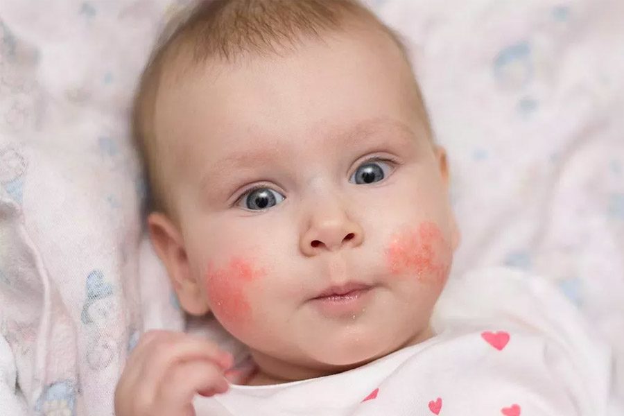 Фенистил капли для детей - идеально облегчает аллергические реакции