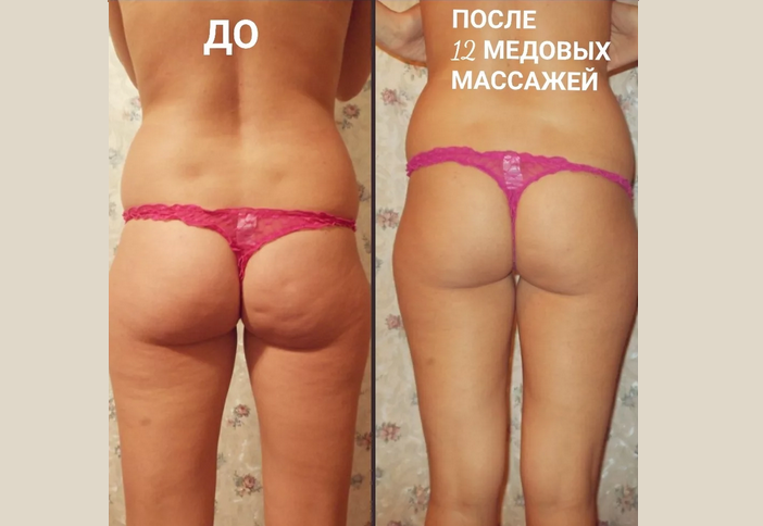 Результаты медового массажа от целлюлита в домашних условиях