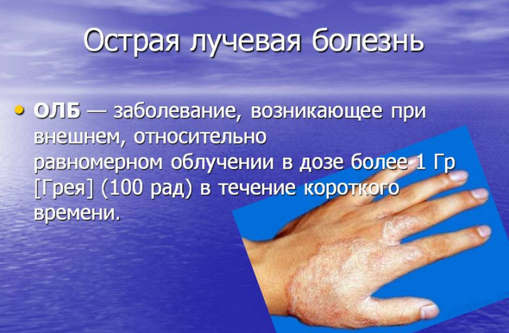 Острая лучевая болезнь