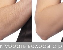 Волосы на руках у девушек: причины, почему начали расти черные, длинные волосы, как избавиться, способы, фото, приметы. Что лучше и эффективнее лазерная или фотоэпиляция?