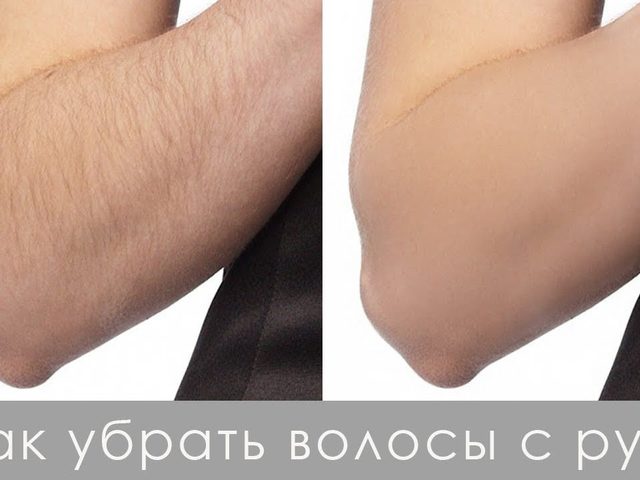 Волосы на руках у девушек: причины, почему начали расти черные, длинные волосы, как избавиться, способы, фото, приметы. Что лучше и эффективнее лазерная или фотоэпиляция?