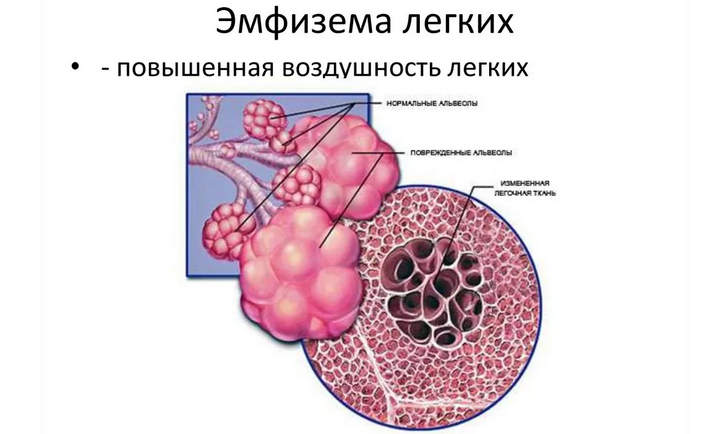 Эмфизема легких