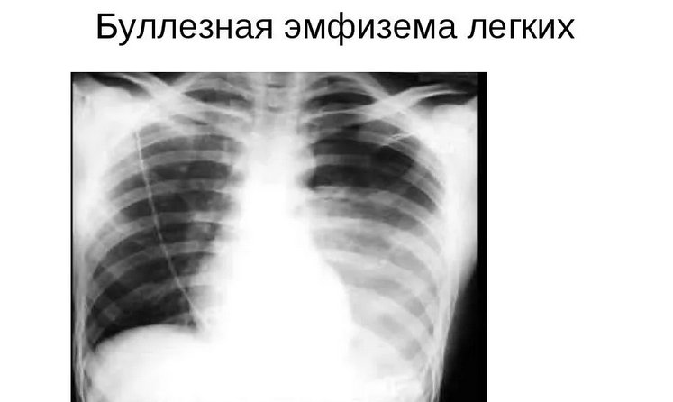 Буллезная эмфизема легких