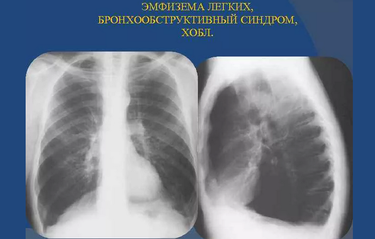 Хобл – хроническая обструктивная эмфизема легких