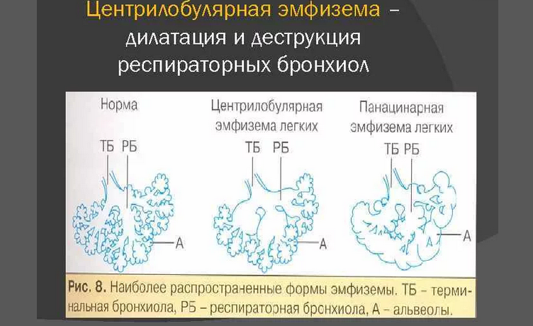 Центрилобулярная эмфизема легких