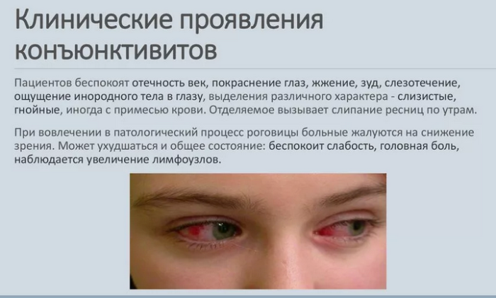 Заболевания, при которых бывают выделения из глаз белого цвета у детей, женщин, мужчин