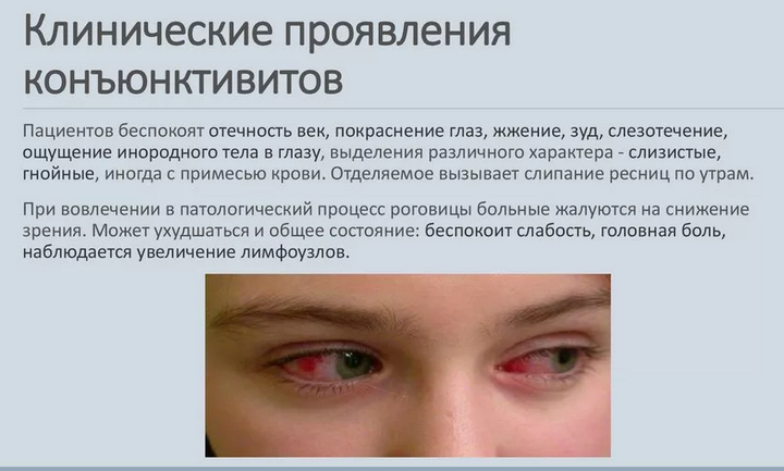 Заболевания, при которых бывают выделения из глаз белого цвета у детей, женщин, мужчин