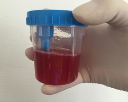 Почему моча имеет красноватый оттенок: при каких заболеваниях, неопасные, патологические причины, дополнительные симптомы, лечение