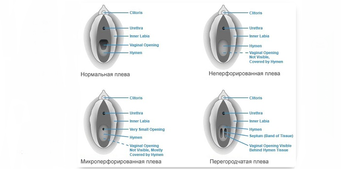 Тампон можно ставить при нормальной плеве