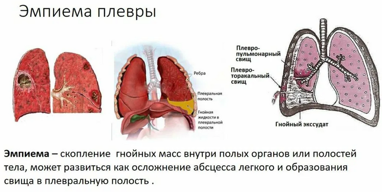 Эмпиема — заболевание плевры