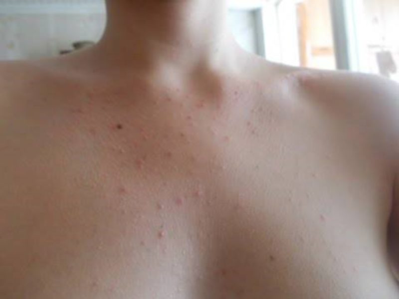 Прыщи на груди означают чувство унижения от значимого человека
