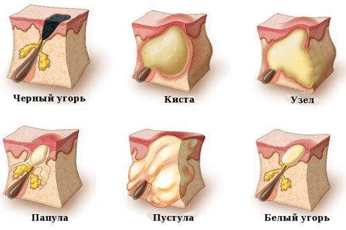 Какие бывают прыщи на лице?