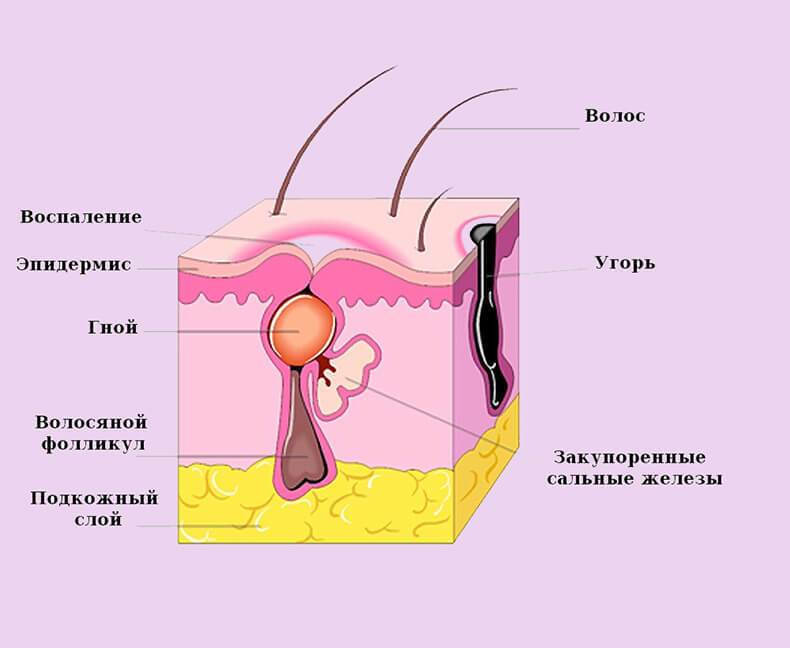 Гнойный прыщ
