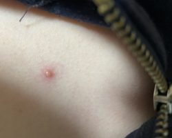 Прыщ на груди, в зоне декольте у девушки, женщины, мужчины: приметы, суеверия
