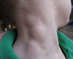 Что делать, если воспалился лимфоузел под челюстью: к какому врачу обращаться, чем лечить? Подчелюстной лимфаденит: причины, последствия