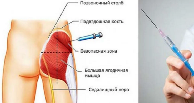 Шишки после уколов появляются, так как неправильно сделана инъекция