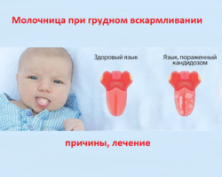Лечение молочницы при грудном вскармливании у матери и ребенка: советы, симптомы, отзывы