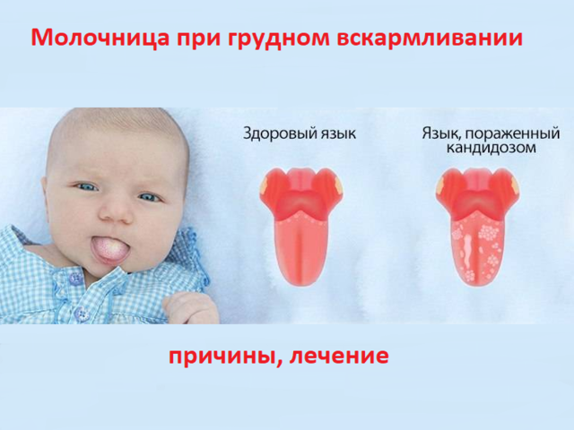 Лечение молочницы при грудном вскармливании у матери и ребенка: советы, симптомы, отзывы
