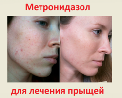 Эффективность Метронидазола в лечении прыщей на лице: механизм действия антибиотика, помогает ли, рецепты масок, болтушки, масок