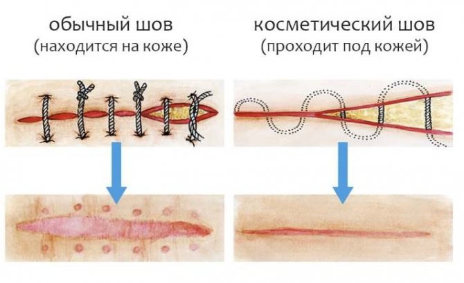 Отличия хирургического и косметического шва