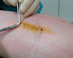 Чем отличается косметический шов от обычного?