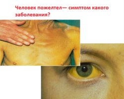 Если человек пожелтел, какое может быть заболевание: причины, что делать? Почему желтеет кожа, лицо, тело, глаза человека: что это значит?