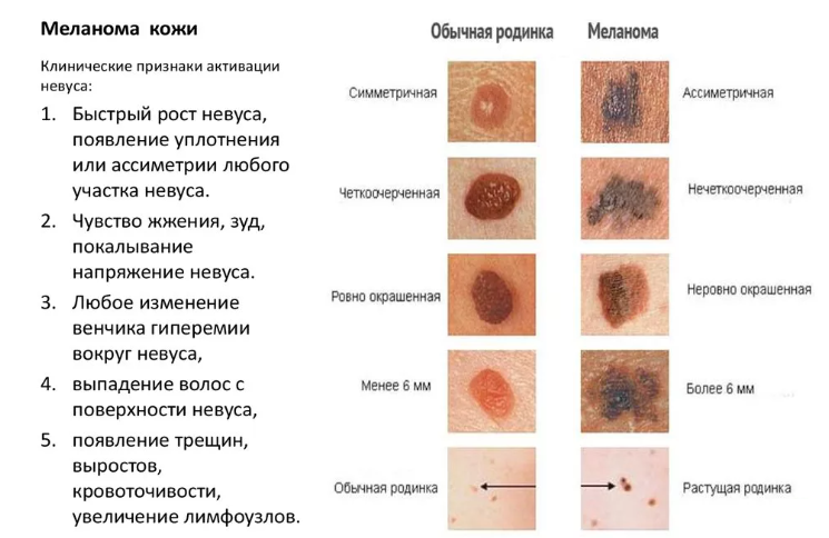 Родинка чешется и растет – это может быть меланома