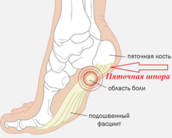 Народные домашние рецепты лечения пяточной шпоры: с сывороткой, песком, глиной, острым перцем, картофелем, аспирином, чесноком, йодом, льдом. Рецепт бабушки Любы — лечение пяточной шпоры