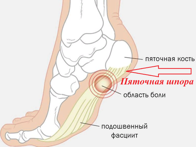 Народные домашние рецепты лечения пяточной шпоры: с сывороткой, песком, глиной, острым перцем, картофелем, аспирином, чесноком, йодом, льдом. Рецепт бабушки Любы — лечение пяточной шпоры