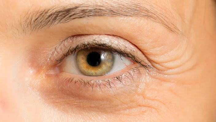 Морщины вокруг глаз