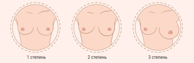 Степени асимметрии груди у женщин