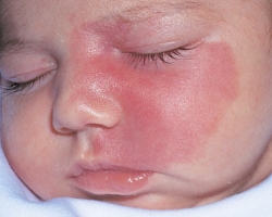 Hemangióma kezelés gyermekeknél. Hemangiomák a fején, arcán, hátán, máj. Hemangiómákkal történő eltávolítás lézerrel