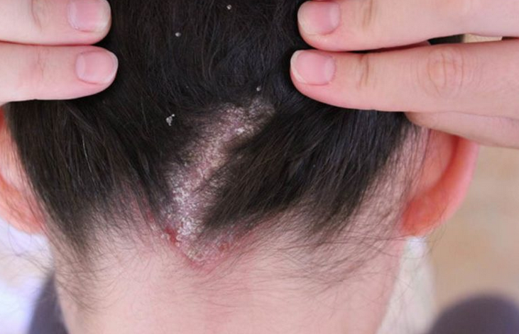 Psoriasis - red spots and sores on the back of the head