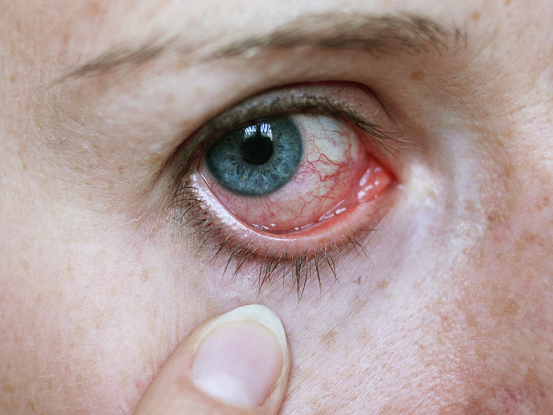 Если краснота глаз сочетается с болью и слезоточивостью, то необходимо немедленно обратиться к врачу