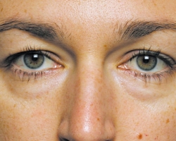 Eye tumor: Reasons, how to get rid of when to see a doctor immediately?