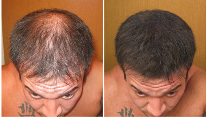 Pertumbuhan rambut di kepala setelah menggunakan megaspray rambut