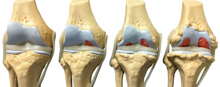 Gonarthrosis of the knee joint