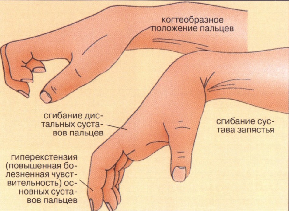 The condition of the wrist