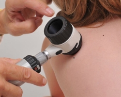 Cara membedakan tahi lalat dari melanoma: tanda -tanda degenerasi kelembaban dalam melanoma. Berapa lama tahi lalat terlahir kembali menjadi melanoma? Seperti apa melanoma pada tahap awal: foto