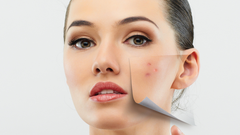 À huileux, l'acné apparaît souvent sur la peau grasse